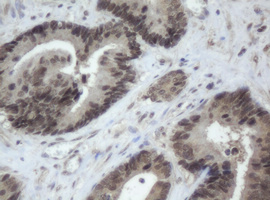CBX8 Antibody - IHC of paraffin-embedded Adenocarcinoma of Human colon tissue using anti-CBX8 mouse monoclonal antibody. (Heat-induced epitope retrieval by 10mM citric buffer, pH6.0, 120°C for 3min).