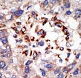 CBX8 Antibody - Formalin-fixed and paraffin-embedded human cancer tissue reacted with the primary antibody, which was peroxidase-conjugated to the secondary antibody, followed by DAB staining. This data demonstrates the use of this antibody for immunohistochemistry; clinical relevance has not been evaluated. BC = breast carcinoma; HC = hepatocarcinoma.