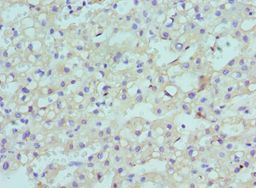 CBX8 Antibody - Immunohistochemistry of paraffin-embedded human liver cancer using antibody at 1:100 dilution.