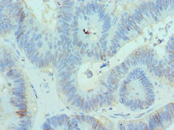 CBX8 Antibody - Immunohistochemistry of paraffin-embedded human colon cancer using CBX8 Antibody at dilution of 1:100