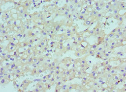 CBX8 Antibody - Immunohistochemistry of paraffin-embedded human liver cancer using CBX8 Antibody at dilution of 1:100