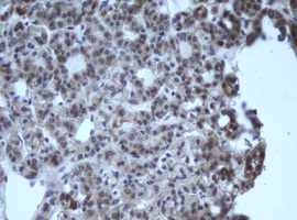 CBX8 Antibody - IHC of paraffin-embedded Carcinoma of Human thyroid tissue using anti-CBX8 mouse monoclonal antibody.