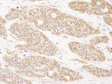 CC2D1A Antibody - Detection of Human CC2D1A by Immunohistochemistry. Sample: FFPE section of human breast carcinoma Antibody: Affinity purified rabbit anti-CC2D1A7 used at a dilution of 1:250.
