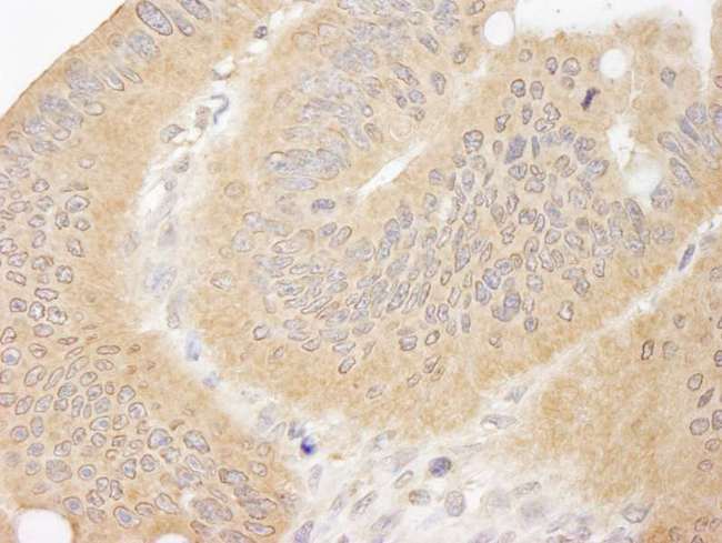CC2D1A Antibody - Detection of Human CC2D1A by Immunohistochemistry. Sample: FFPE section of human colon carcinoma. Antibody: Affinity purified rabbit anti-CC2D1A used at a dilution of 1:1000 (1 ug/ml).