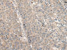 CC2D1A Antibody - Immunohistochemistry of paraffin-embedded Human liver cancer tissue  using CC2D1A Polyclonal Antibody at dilution of 1:35(×200)