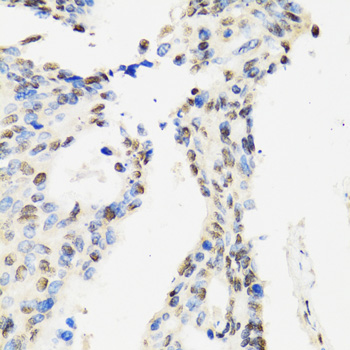 CCAR2 / KIAA1967 Antibody - Immunohistochemistry of paraffin-embedded human rectal cancer tissue.