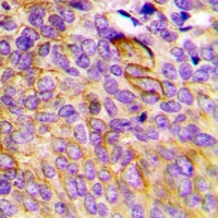 CCBL1 Antibody - Immunohistochemical analysis of CCBL1 staining in human breast cancer formalin fixed paraffin embedded tissue section. The section was pre-treated using heat mediated antigen retrieval with sodium citrate buffer (pH 6.0). The section was then incubated with the antibody at room temperature and detected using an HRP conjugated compact polymer system. DAB was used as the chromogen. The section was then counterstained with hematoxylin and mounted with DPX.