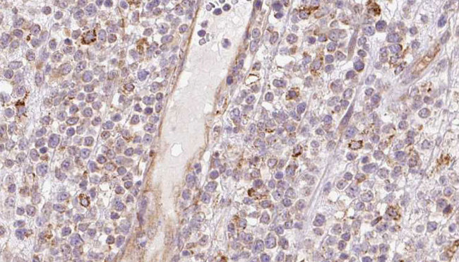 CCBL1 Antibody - 1:100 staining human lymph carcinoma tissue by IHC-P. The sample was formaldehyde fixed and a heat mediated antigen retrieval step in citrate buffer was performed. The sample was then blocked and incubated with the antibody for 1.5 hours at 22°C. An HRP conjugated goat anti-rabbit antibody was used as the secondary.