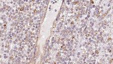 CCBL1 Antibody - 1:100 staining human lymph carcinoma tissue by IHC-P. The sample was formaldehyde fixed and a heat mediated antigen retrieval step in citrate buffer was performed. The sample was then blocked and incubated with the antibody for 1.5 hours at 22°C. An HRP conjugated goat anti-rabbit antibody was used as the secondary.