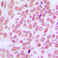 CCDC102B Antibody - Immunohistochemical analysis of CCDC102B staining in human breast cancer formalin fixed paraffin embedded tissue section. The section was pre-treated using heat mediated antigen retrieval with sodium citrate buffer (pH 6.0). The section was then incubated with the antibody at room temperature and detected using an HRP conjugated compact polymer system. DAB was used as the chromogen. The section was then counterstained with hematoxylin and mounted with DPX.