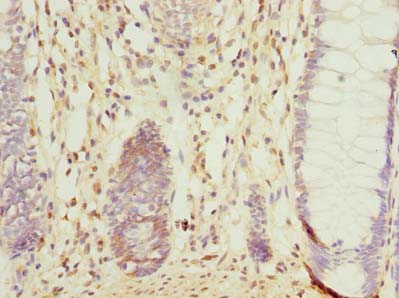 CCDC106 Antibody - Immunohistochemistry of paraffin-embedded human colon cancer using antibody at dilution of 1:100.