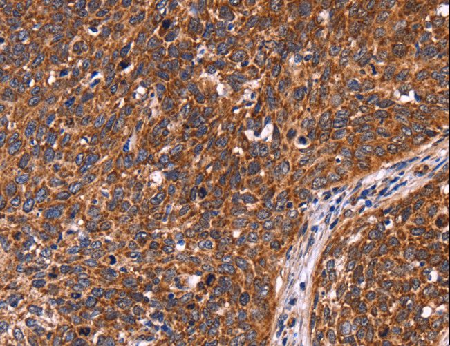 CCDC106 Antibody - Immunohistochemistry of paraffin-embedded Human colon cancer using CCDC106 Polyclonal Antibody at dilution of 1:60.