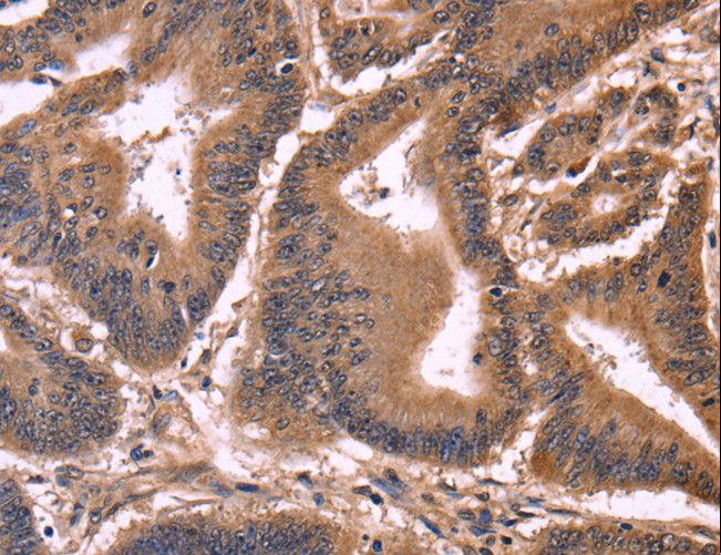 CCDC106 Antibody - Immunohistochemistry of paraffin-embedded Human cervical cancer using CCDC106 Polyclonal Antibody at dilution of 1:50.