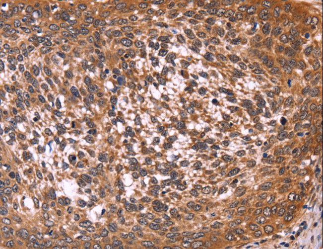 CCDC106 Antibody - Immunohistochemistry of paraffin-embedded Human cervical cancer using CCDC106 Polyclonal Antibody at dilution of 1:50.