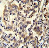 CCDC110 Antibody - CCDC110 Antibody immunohistochemistry of formalin-fixed and paraffin-embedded human testis carcinoma followed by peroxidase-conjugated secondary antibody and DAB staining.