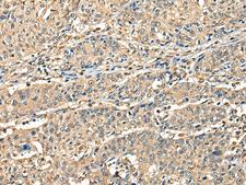 CCDC112 / MBC1 Antibody - Immunohistochemistry of paraffin-embedded Human prost at e cancer tissue  using CCDC112 Polyclonal Antibody at dilution of 1:45(×200)