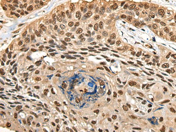 CCDC112 / MBC1 Antibody - Immunohistochemistry of paraffin-embedded Human esophagus cancer tissue  using CCDC112 Polyclonal Antibody at dilution of 1:45(×200)