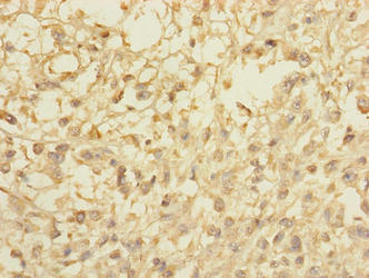 CCDC113 Antibody - Immunohistochemistry of paraffin-embedded human melanoma using CCDC113 Antibody at dilution of 1:100
