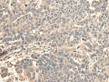 CCDC113 Antibody - Immunohistochemistry of paraffin-embedded Human liver cancer tissue  using CCDC113 Polyclonal Antibody at dilution of 1:65(×200)