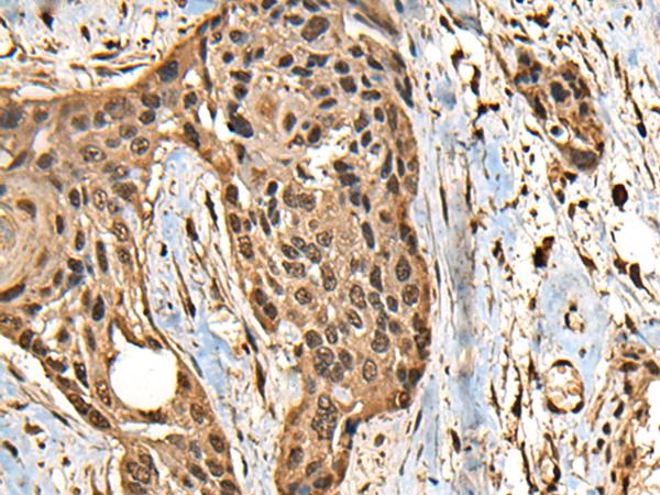 CCDC113 Antibody - Immunohistochemistry of paraffin-embedded Human esophagus cancer tissue  using CCDC113 Polyclonal Antibody at dilution of 1:65(×200)