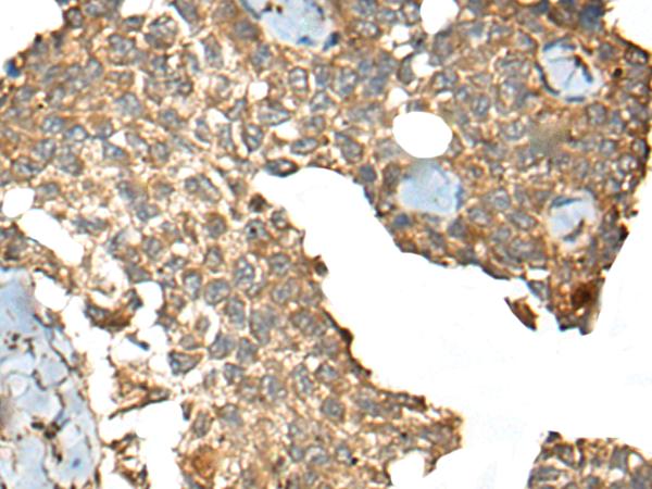 CCDC113 Antibody - Immunohistochemistry of paraffin-embedded Human ovarian cancer tissue  using CCDC113 Polyclonal Antibody at dilution of 1:35(×200)