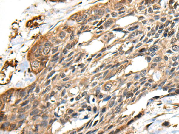 CCDC113 Antibody - Immunohistochemistry of paraffin-embedded Human esophagus cancer tissue  using CCDC113 Polyclonal Antibody at dilution of 1:35(×200)