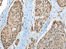CCDC12 Antibody - Immunohistochemistry of paraffin-embedded Human esophagus cancer tissue  using CCDC12 Polyclonal Antibody at dilution of 1:50(×200)