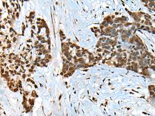 CCDC12 Antibody - Immunohistochemistry of paraffin-embedded Human thyroid cancer tissue  using CCDC12 Polyclonal Antibody at dilution of 1:60(×200)