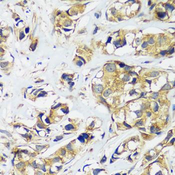 CCDC124 Antibody - Immunohistochemistry of paraffin-embedded Human breast cancer using CCDC124 Polyclonal Antibody at dilution of 1:100 (40x lens).