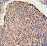 CCDC130 Antibody - CC130 Antibody IHC of formalin-fixed and paraffin-embedded human lung carcinoma followed by peroxidase-conjugated secondary antibody and DAB staining.