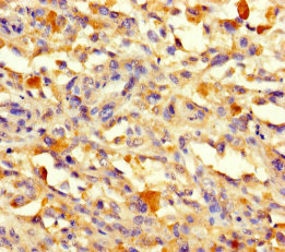 CCDC132 Antibody - Immunohistochemistry of paraffin-embedded human melanoma using VPS50 Antibody at dilution of 1:100