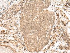 CCDC132 Antibody - Immunohistochemistry of paraffin-embedded Human esophagus cancer tissue  using VPS50 Polyclonal Antibody at dilution of 1:45(×200)