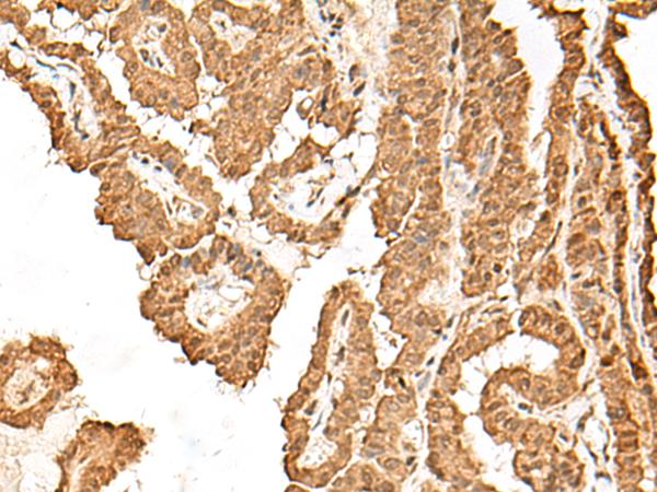 CCDC132 Antibody - Immunohistochemistry of paraffin-embedded Human thyroid cancer tissue  using VPS50 Polyclonal Antibody at dilution of 1:45(×200)