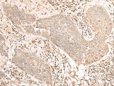 CCDC132 Antibody - Immunohistochemistry of paraffin-embedded Human esophagus cancer tissue  using VPS50 Polyclonal Antibody at dilution of 1:30(×200)