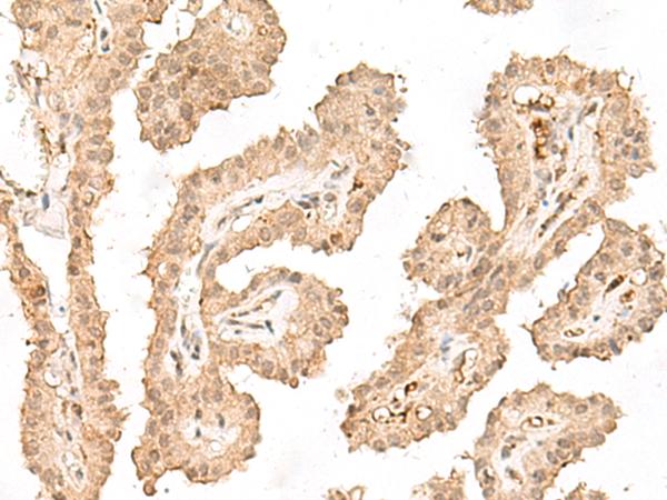 CCDC132 Antibody - Immunohistochemistry of paraffin-embedded Human thyroid cancer tissue  using VPS50 Polyclonal Antibody at dilution of 1:30(×200)