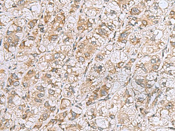 CCDC134 Antibody - Immunohistochemistry of paraffin-embedded Human liver cancer tissue  using CCDC134 Polyclonal Antibody at dilution of 1:50(×200)