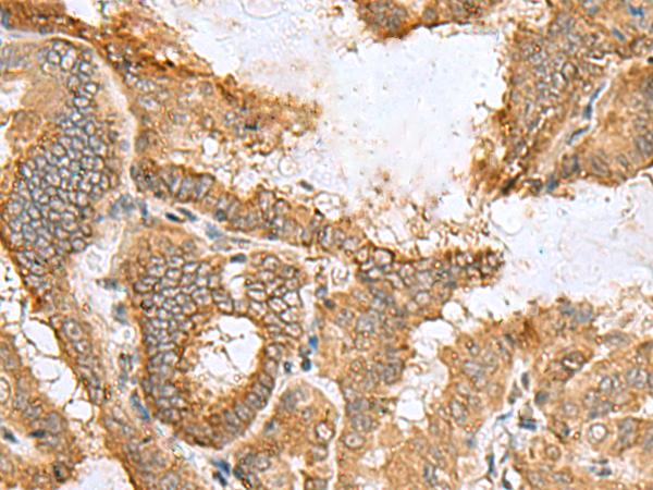 CCDC134 Antibody - Immunohistochemistry of paraffin-embedded Human thyroid cancer tissue  using CCDC134 Polyclonal Antibody at dilution of 1:50(×200)
