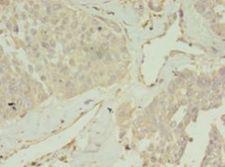 CCDC14 Antibody - Immunohistochemistry of paraffin-embedded human endometrial cancer using antibody at 1:100 dilution.  This image was taken for the unconjugated form of this product. Other forms have not been tested.