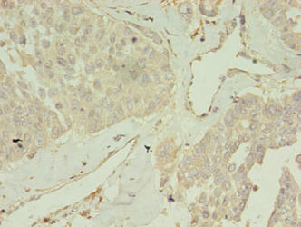 CCDC14 Antibody - Immunohistochemistry of paraffin-embedded human endometrial cancer using CCDC14 Antibody at dilution of 1:100