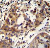 CCDC17 Antibody - CCDC17 antibody immunohistochemistry of formalin-fixed and paraffin-embedded human breast carcinoma followed by peroxidase-conjugated secondary antibody and DAB staining.