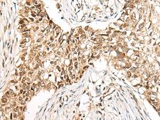 CCDC181 / C1orf114 Antibody - Immunohistochemistry of paraffin-embedded Human lung cancer tissue  using CCDC181 Polyclonal Antibody at dilution of 1:50(×200)