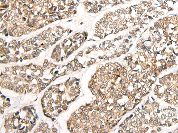 CCDC181 / C1orf114 Antibody - Immunohistochemistry of paraffin-embedded Human esophagus cancer tissue  using CCDC181 Polyclonal Antibody at dilution of 1:50(×200)