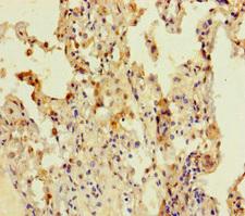 CCDC184 Antibody - Immunohistochemistry of paraffin-embedded human lung cancer using CCDC184 Antibody at dilution of 1:100