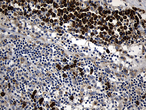 CCDC22 Antibody - Immunohistochemical staining of paraffin-embedded Carcinoma of Human bladder tissue using anti-CCDC22 mouse monoclonal antibody. (Heat-induced epitope retrieval by 1mM EDTA in 10mM Tris buffer. (pH8.5) at 120°C for 3 min. (1:500)