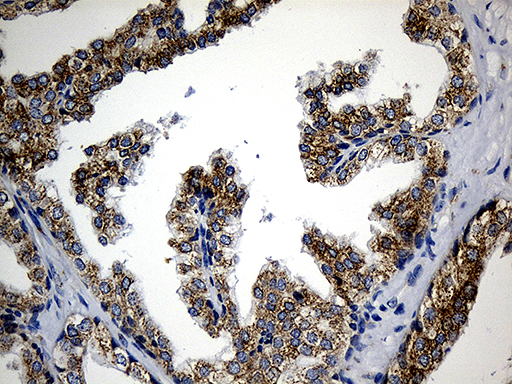 CCDC22 Antibody - Immunohistochemical staining of paraffin-embedded Carcinoma of Human prostate tissue using anti-CCDC22 mouse monoclonal antibody. (Heat-induced epitope retrieval by 1mM EDTA in 10mM Tris buffer. (pH8.5) at 120°C for 3 min. (1:500)