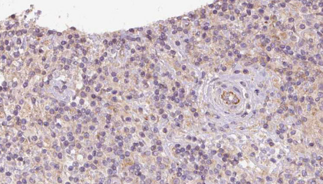 CCDC22 Antibody - 1:100 staining human lymph carcinoma tissue by IHC-P. The sample was formaldehyde fixed and a heat mediated antigen retrieval step in citrate buffer was performed. The sample was then blocked and incubated with the antibody for 1.5 hours at 22°C. An HRP conjugated goat anti-rabbit antibody was used as the secondary.