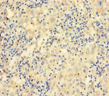 CCDC36 Antibody - Immunohistochemistry of paraffin-embedded human lung cancer using CCDC36 Antibody at dilution of 1:100