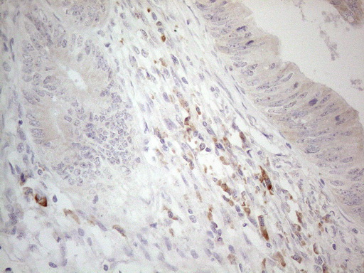 CCDC36 Antibody - Immunohistochemical staining of paraffin-embedded Adenocarcinoma of Human colon tissue using anti-CCDC36 mouse monoclonal antibody. (Heat-induced epitope retrieval by 1mM EDTA in 10mM Tris buffer. (pH8.5) at 120°C for 3 min. (1:150)