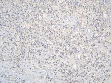 CCDC36 Antibody - IHC staining of FFPE human testis cancer with CCDC36 antibody at 1ug/ml. HIER: boil tissue sections in pH6, 10mM citrate buffer, for 10-20 min and allow to cool before testing.