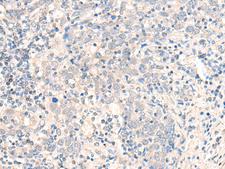 CCDC47 Antibody - Immunohistochemistry of paraffin-embedded Human cervical cancer tissue  using CCDC47 Polyclonal Antibody at dilution of 1:25(×200)